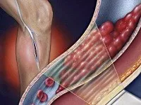 Trombózis a mély vénák (trombózis) Thrombosis a mély vénák az alsó végtagok