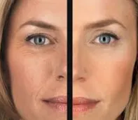 Beauty injekciók, radiolifting arca - a következményeket, és felülvizsgálja az orvos