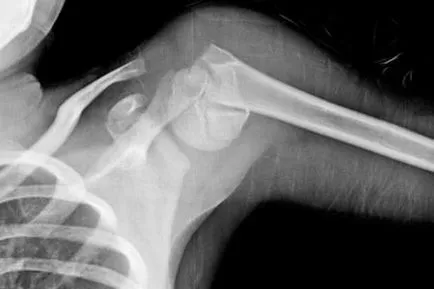 Contusio a vállízület, és a kezelést a tünetek a trauma (kezelés) Contusio a vállízület és tüneteinek kezelésére trauma