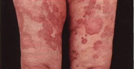 Vasculitis - diagnózis, a tünetek, az osztályozás és a kezelés a betegség (tünetek) Vasculitis - diagnózis, a tünetek, az osztályozás és a kezelés a betegség