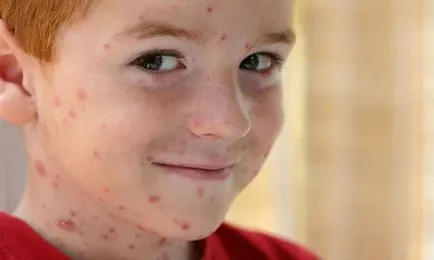 A bárányhimlő előtt, és annak kezelése