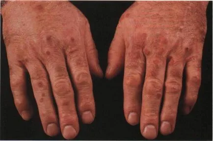 Vasculitis - diagnózis, a tünetek, az osztályozás és a kezelés a betegség (kezelés) Vasculitis - diagnózis, a tünetek, az osztályozás és a kezelés a betegség
