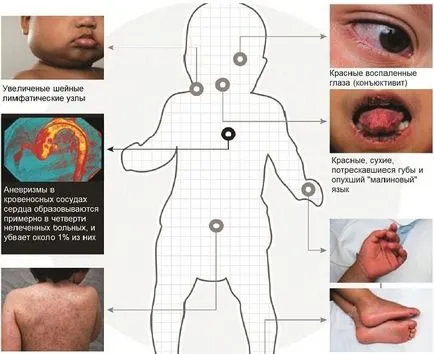 Vasculitis - diagnózis, a tünetek, az osztályozás és a kezelés a betegség (diagnózis) Vasculitis - diagnózis, a tünetek, az osztályozás és a kezelés a betegség