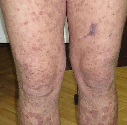 Vasculitis - diagnózis, a tünetek, az osztályozás és a kezelés a betegség (diagnózis) Vasculitis - diagnózis, a tünetek, az osztályozás és a kezelés a betegség