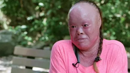 Túlélni a harlekin ichthyosis
