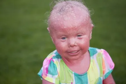 Túlélni a harlekin ichthyosis