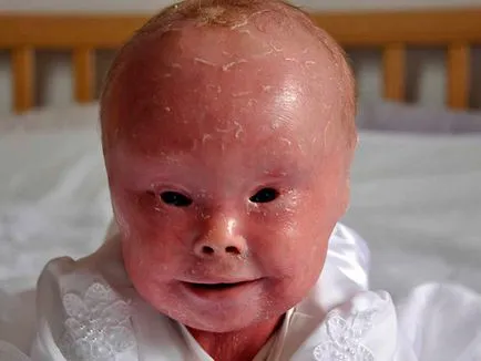 Túlélni a harlekin ichthyosis