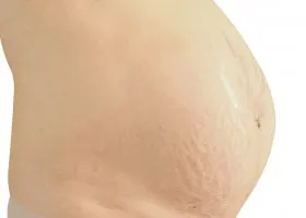 Betakarítás stretching alkalmazásával mandulaolaj (édes mandulaolaj) Távolítsuk striák segítségével mandulaolaj