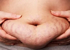 Betakarítás stretching alkalmazásával mandulaolaj (elasztin, kollagén termelést) Távolítsuk striák segítségével mandulaolaj