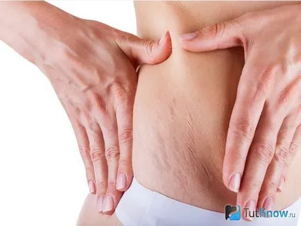 Betakarítás stretching alkalmazásával mandulaolaj (striák) Távolítsuk striák segítségével mandulaolaj
