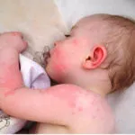 Allergia a csapvíz okoz és allergiás tünetek (víz) allergiás a víz a csapból okait és az allergia tüneteinek