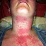 Allergia víz - tengeri, a tünetek, lehet viszont, a csapból a kapor (tengeri) Allergia víz - tengeri, a tünetek lehetnek a kezét, a csapból a kapor,