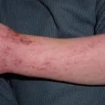 Allergia mosószer tünetei, kezelése és fotó megnyilvánuló allergia felnőtteknél (tünetek) Allergia mosószer tünetei, kezelése és fotó megnyilvánuló allergia felnőtteknél
