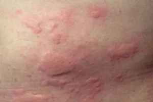 Allergiás a por - tünetek és kezelés (tünetek) Allergiás a por - tünetek és kezelés