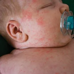 Allergiás a por a gyermek, mint látható, a 6. és a 4 kockázati tényezők a fő allergén