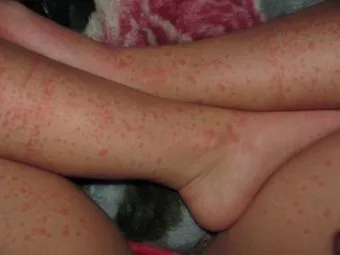 Allergia mosópor - tünetek, hogy foglalkozni kell együtt ok (allergia) Allergia mosópor - tünetek, hogy foglalkozni kell együtt az oka