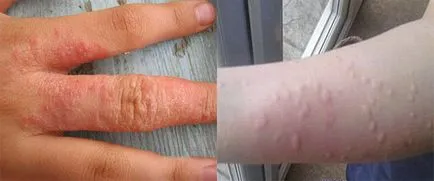 Allergia mosószer okai, tünetei, megelőzése (ok) Allergia mosópor okok, tünetek, megelőzési