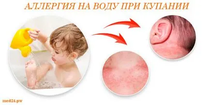 Allergia a víz, a tünetek, allergia kezelésére (allergia) Allergiás a víz, a tünetek, allergia kezelése
