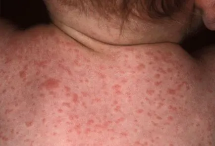 Allergia mosópor felnőttek és gyermekek - egy fotót az allergiás reakció