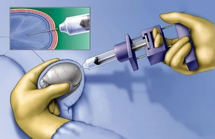 Biopsziás - módszer megerősítését rák bármely formáját