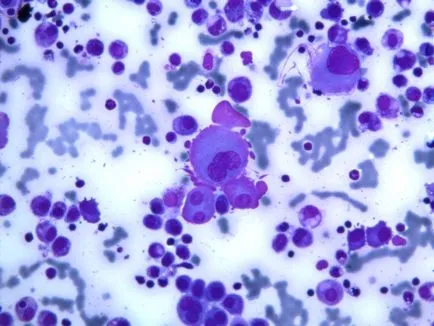 Biopsziás - módszer megerősítését rák bármely formáját