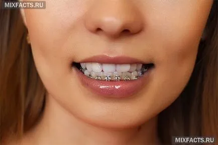Melles, hogyan kell viselni, és hogyan néz ki (rajta) Melles, hogyan kell viselni, és hogyan kell nézni