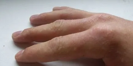 Viszkető ujjak - okai a viszketés és irritáció, mint egy élvezet otthon (kéz) Viszkető ujjak - okai a viszketés és irritáció, mint egy élvezet otthon