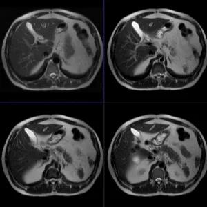 MRI mutatja, hogy a hasüregbe egy kontraszt készítmény, amely hatóságok ellenőrzik ár