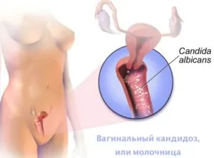 Mi a szájpenész kezelésére, a tünetek, jelek, és hogyan lehet megszabadulni, amit úgy tűnik candidiasis (a) Mi a szájpenész kezelésére, a tünetek, jelek, és hogyan lehet megszabadulni, amit úgy tűnik candidiasis