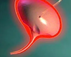 Hólyaghurut nőknél vérkezelést, okok, mit kell csinálni (cystitis) Hólyaghurut nőknél vérkezelést, okok, mit kell tenni