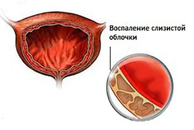 Cystitis vérrel vizelés közben okok és a kezelés (Bearberry levél vörösáfonya) Cystitis vérrel vizelés közben okok és a kezelés