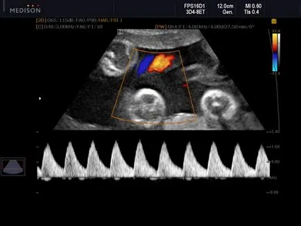 Magzati Doppler dekódolás paraméterek a terhesség alatt, ultrahang szabványok