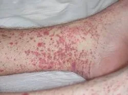 rheumatocelis