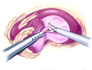 Hyperechoic zárványok a vesében típusú, a tünetek, a kezelés (vese) Hyperechoic zárványok a vesében típusú, a tünetek, a kezelés