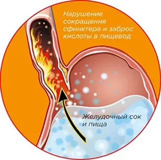 Gyomorégés, hogyan lehet megszabadulni a otthon Gyomorégés, hogyan lehet megszabadulni a otthon