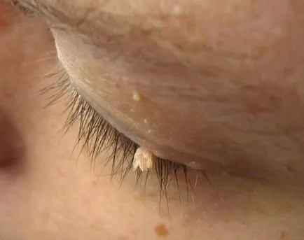 Hogyan kell biztonságosan eltávolítani papilloma otthon (papilloma) Hogyan kell biztonságosan eltávolítani papilloma otthon