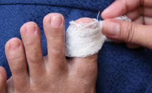 Nail zúzódás a karján és a lábán, hogy otthon (kéz) Nail zúzódás a karján és a lábán, hogy otthon