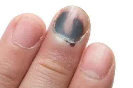 Nail zúzódás a karján és a lábán, hogy otthon (köröm) Nail zúzódás a karján és a lábán, hogy otthon