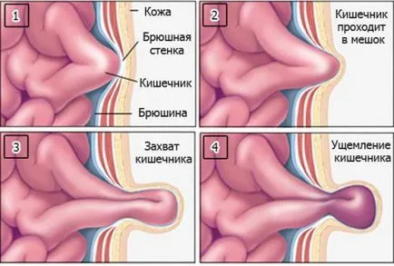 Strangulált sérv, jellegét, típusok, a tünetek és a kezelés (strangulated sérv) Strangulated sérv, jellegét, típusai, tünetei és kezelése