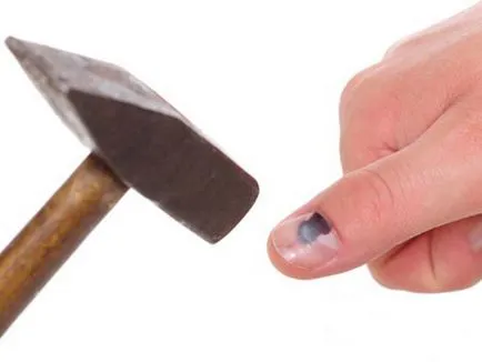 Nail zúzódás a karján és a lábán, hogy otthon (láb) Nail zúzódás a karján és a lábán, hogy otthon