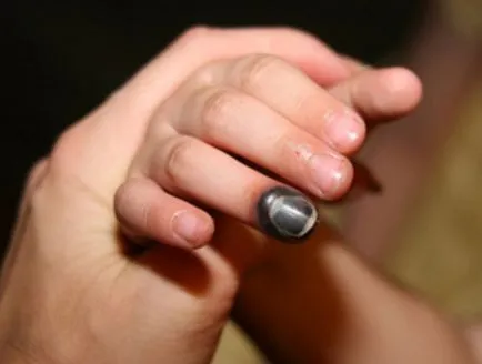 Nail zúzódás a karján és a lábán, hogy otthon (kéz) Nail zúzódás a karján és a lábán, hogy otthon