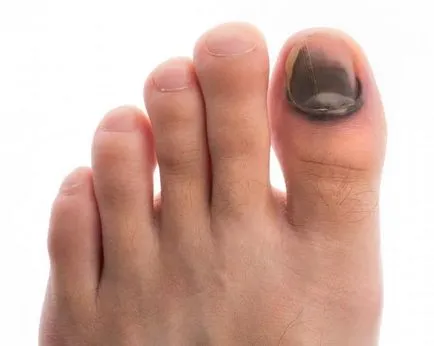Nail zúzódás a karján és a lábán, hogy otthon (köröm) Nail zúzódás a karján és a lábán, hogy otthon