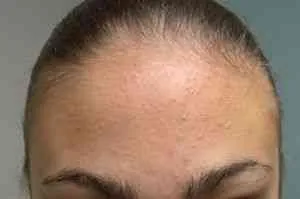Hogyan akne kezelésére a homlokán - akne kezelés - cikkek Directory - hogyan lehet szép (acne) Hogyan akne kezelésére a homlokán - akne kezelés - cikkek Directory - hogyan lehet szép