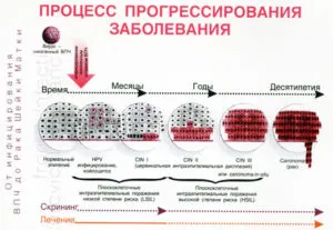 Hogyan kell kezelni a humán papillomavírus a leghatékonyabb módszerek