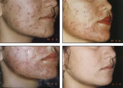 Hogyan akne kezelésére - kérdések és válaszok (acne) Hogyan akne kezelésére - kérdések és válaszok