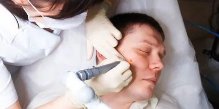 Hogyan kezelik a papilloma - a módszereket és eszközöket a vírus elleni harcra, a hulladékkezelési módszerek és kezelés (vírus) Hogyan kezelik a papilloma - a módszereket és eszközöket a vírus elleni harcra, a hulladékkezelési módszerek és kezelési