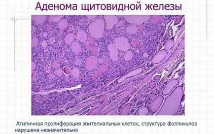 A csomópontok a pajzsmirigyben nők tünetei és kezelése azaz milyen következményekkel jár (kezelés) A csomópontok a pajzsmirigyben nők tünetei és kezelése, azaz milyen következményekkel