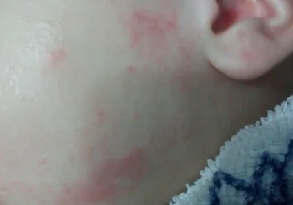 Hogyan allergia mosópor, allergia megáll