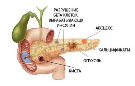 Hogyan működik a hasnyálmirigy emberben