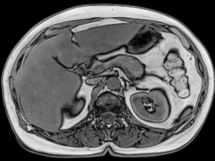 Hogyan, hogy felkészüljön egy MRI a hasüreg (üregek) Hogyan készüljünk fel egy MRI a has